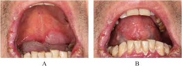 Syphilitic chancre is a solitary, painless, indurated, reddish ulcer, accompanied by regional lymphadenopathy (1), which is localized at the site of treponema pallidum (tp) inoculation and usually resolves after approximately one month (1). Diagnosis Of Oral Syphilis Remains A Challenge A Case Report International Journal Of Infectious Diseases