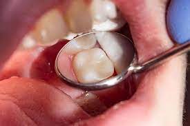 علاج طبيعي لتسوس الأسنان 