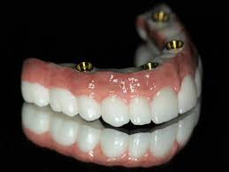 Clear Choice Dental Implants Cost: How Much Do They Cost?