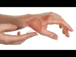 كيف تعالج الحروق الإسعافات الأولية في حالات الطوارئ Youtube