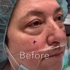 Lower blepharoplasty surgery with laser resurfacing and canthoplasty can  help permanently reduce dark circles and bags under your eyes. A wonderful,  refreshing surgery. #blepharoplasty #undereyebags ...