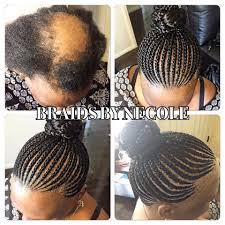 14 Extraordinary Alopecia Camouflage Cornrows By Braids By Necole Braids For Thin Hair Hair Styles Alopecia Hairstyles