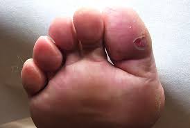 Image result for diabetic toes