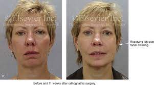 16 Complications Associated With Orthognathic Surgery Pocket Dentistry