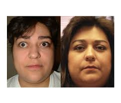 Thyroid Eye Problems Graves Disease Fante Eye Face Centre Thyroid Removal Surgery Thyroid Disease Symptoms Thyroid