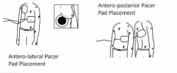 Image result for Transcutaneous Pacing