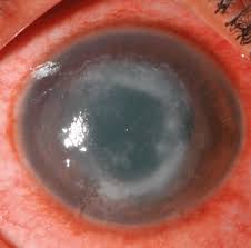 Consult a doctor for medical advice. How To Diagnose And Treat Acanthamoeba Keratitis Eye News