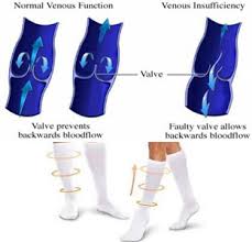 Check spelling or type a new query. Blog Medias De Compresion Pueden Ayudar Con La Tromboflebitis Superficial