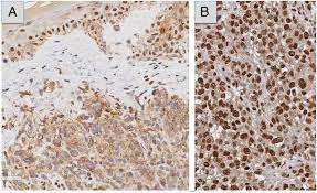 Formerly called atypical spitz tumors), and the following cancers, in descending order of frequency: Gene Of The Month Bap1 Journal Of Clinical Pathology