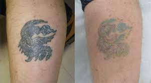Compared to other tattoo removal techniques, the revolutionary tat b gone tattoo removal system helps remove your tattoo artwork or permanent cosmetics, easily. Best Tattoo Removal For Green Ink Laser Skin Care Clinic