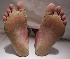 And the comments below it are interesting on the topic. Athlete S Foot Wikipedia