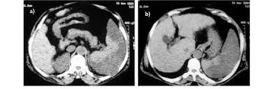 Unenhanced Ct Scan Meaning Ct Scan Machine