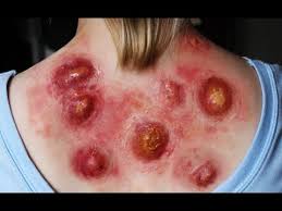 Image result for carbuncle