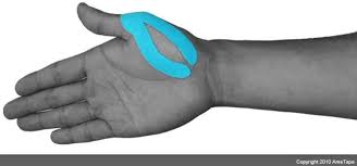 Upper Limbs Vendaje Neuromuscular Vendaje Consejos De Supervivencia
