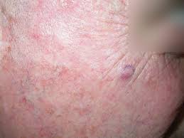 Image result for Merkel Cell Carcinoma