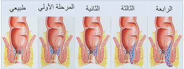 تعرف على شكل البواسير بالصور الحقيقية طبيب ويب