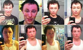 Boy Suffers Severe Allergic Reaction To Hair Dye And Snaps Photos Of Himself As His Face Swells To Twice Its Normal Size Dyed Hair Hair Face
