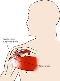 A prominent ridge of the scapula that extends from the acromion across the posterior aspect of the scapula. Rotator Cuff Tears Orthoinfo Aaos