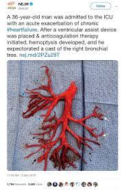 When an injury occurs, the body emits clotting agents to keep blood spillage to a minimum. Man Coughs Up Bizarre Blood Clot Shaped Exactly Like Part Of A Lung News Heraldmailmedia Com