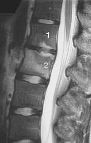 Image result for Low Back Imaging