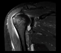 Image result for Shoulder History