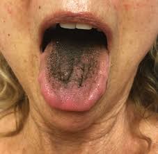 Image result for black tongue symptoms