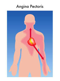 Image result for Angina Pectoris