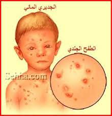 ملف كامل بل صور عن الجديري المائي العنقز chickenpox varicella