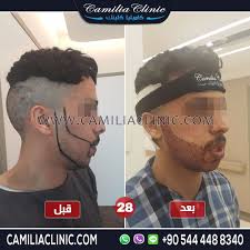 زراعة اللحية في تركيا بكثافة عالية بالصور قبل وبعد مركز كاميليا كلينك متخصصون بـ زراعة و تكثيف الشعر تكثيف شعر اللحية غايتنا تحقيق حلمك بمظهر جذا 90 S