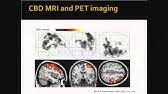 Progressive Supranuclear Palsy Mayo Clinic Radio Youtube