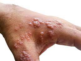 The orthopoxvirus genus also includes variola virus (the cause of smallpox), vaccinia virus (used in the smallpox vaccine), and cowpox virus. Hxqzl1ycg4ra6m