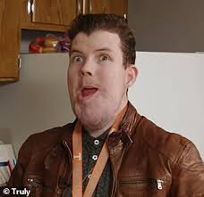 Man born with rare condition that made face deformed reveals he can lose  ability to speak to fix it