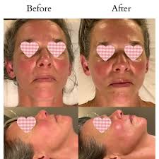 Hi! These are a few of my client's before and after pics from their 60 min  Sculpting Buccal sessions which help reduce swelling, increase circulation  and collagen production, and improve the gravitational