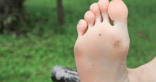 Przeczytaj w naszym artykule na temat objawów i leczenia stopy cukrzycowej. Stopa Cukrzycowa Co To Jest Jakie Sa Jej Objawy Oraz Jak Ja Leczyc Tvn Zdrowie