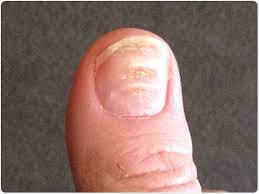 The chronic renal insufficiency cohort (cric) study. What Do Your Nails Say About Kidney Disease Walkin Lab