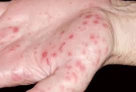 What causes small red dots or bumps on legs? Viral Skin Conditions Pictures Of Rashes Blisters And Sores In Adults And Toddlers