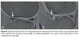 Magnetic Resonance Imaging In The Assessment Of Meniscal Anatomic Variants And Of The Perimeniscal Ligamentous Anatomy Potential Interpretation Pitfalls