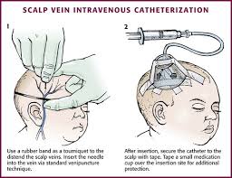 Image result for Difficult Intravenous Access in Children