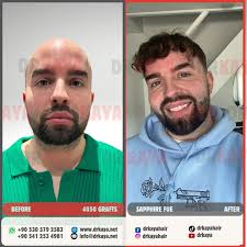 Watch Matthew Nicholas Callan who had a previous surgery in UK, sharing his  experience with us the day after his hair transplant surgery. We do  hundreds of corrections surgeries to people