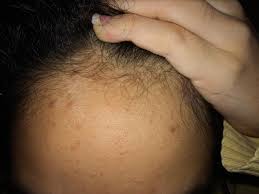 Acne is a disorder of the glands which lie at the base of hair follicles. Pimples On Hairline Forehead Help Please Acne