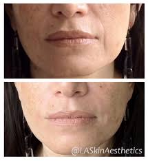 Since smiles are beautiful and these folds on your face are normal, there is no real cause for concern. Instagram Photo By La Skinaesthetics May 23 2016 At 9 19pm Utc Nasolabial Folds Juvederm Esthetics