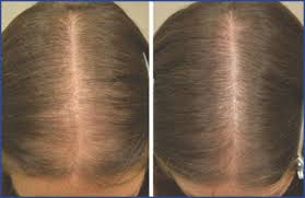 Rogaine for women comes in the form of a foam that you have to apply to your scalp once a day. Medical Therapy For Female Pattern Hair Loss Fphl Hair Transplant Forum International