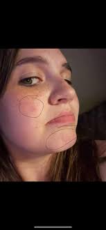 What could be causing acne-like breakouts