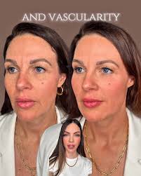 Aging doesn’t happen in one place. It’s a structural shift…bone, fat, and  skin all play a role., This patient’s plan:, • Midface projection with  filler to address cheek flattening, • Radiesse to ...