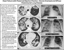 Am i high risk for covid lung complications? Diffuse Parenchymal Lung Disease And Its Mimics Thoracic Key