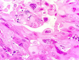 Cmv esophagitis occurs most often in patients with aids or severe immunosuppression. Pathology Outlines Herpes Simplex Esophagitis