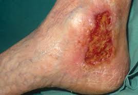 Leg Ulcers Medical Daily News Health News