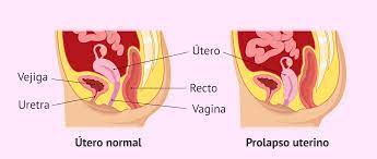 Que Es El Prolapso Uterino Causas Sintomas Y Tratamiento