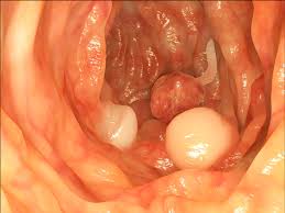 Colonoscopy (/ˌkɒləˈnɒskəpi/) or coloscopy (/kəˈlɒskəpi/) is the endoscopic examination of the large bowel and the distal part of the small bowel with a ccd camera or a fiber optic camera on a flexible. Familial Adenomatous Polyposis Medlineplus Genetics