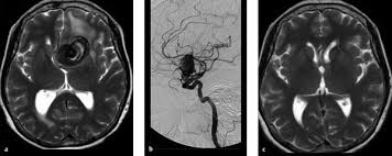 Aneurysms are the result of a weakening of the vascular wall and can be defined as an hereditary. 4 Intracranial Aneurysms Radiology Key
